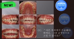 교정 Case 773.  U5L5 발치, Dental Openbite, Sem #7