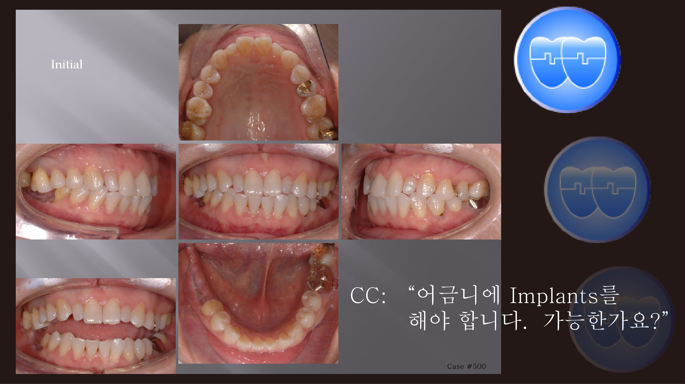 교정 Case 500.  Intrusion of #16 and #17 with Miniscrew, 실패한 Case, Sem #7.7