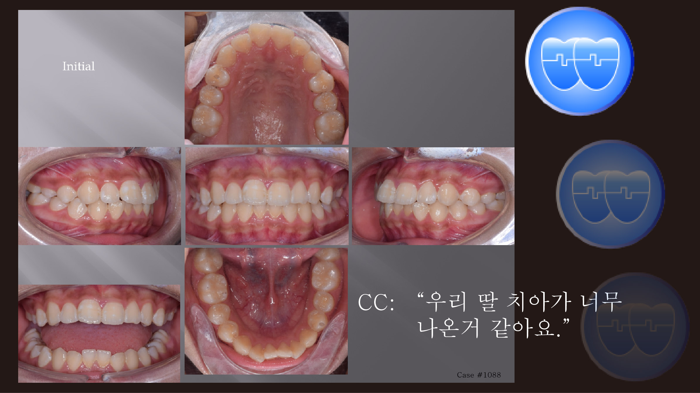 교정 Case 1088. U5L5 발치, Protrusion, Gummy Smile, Sem #12.4