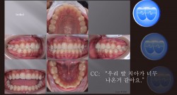 교정 Case 1088. U5L5 발치, Protrusion, Gummy Smile, Sem #12.4