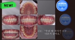 교정 Case 1088.  U5L5 발치, Protrusion, Gummy Smile, Sem #12.4