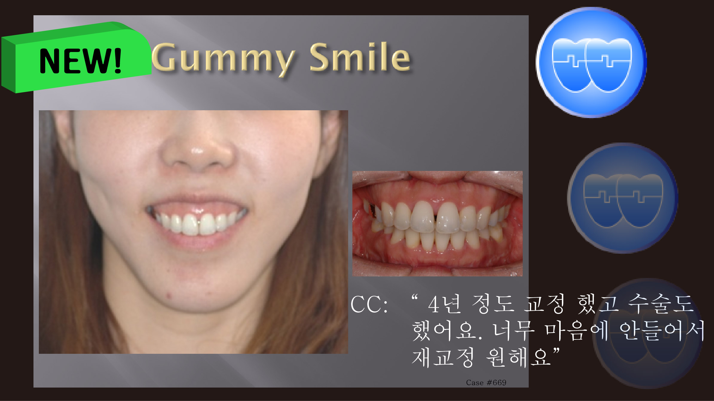 교정 Case 669. U4L4 발치, 재교정, Skeletal Class II, Severe Gummy Smile, Sem 7.5