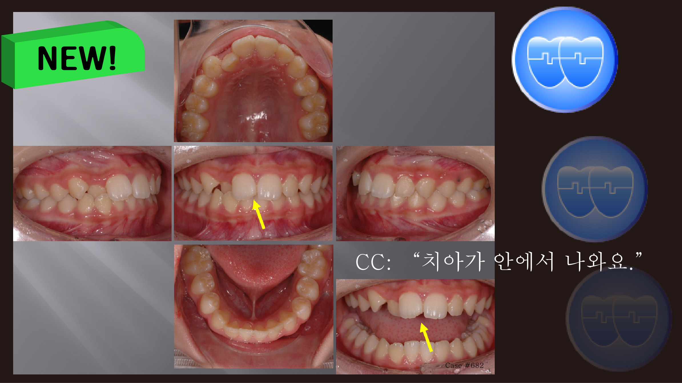 교정 Case 682. 비발치, 시갈 버튼, Broken Incisal Edge, Enameloplasty, Sem #3