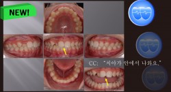 교정 Case 682. 비발치, 시갈 버튼, Broken Incisal Edge, Enameloplasty, Sem #3