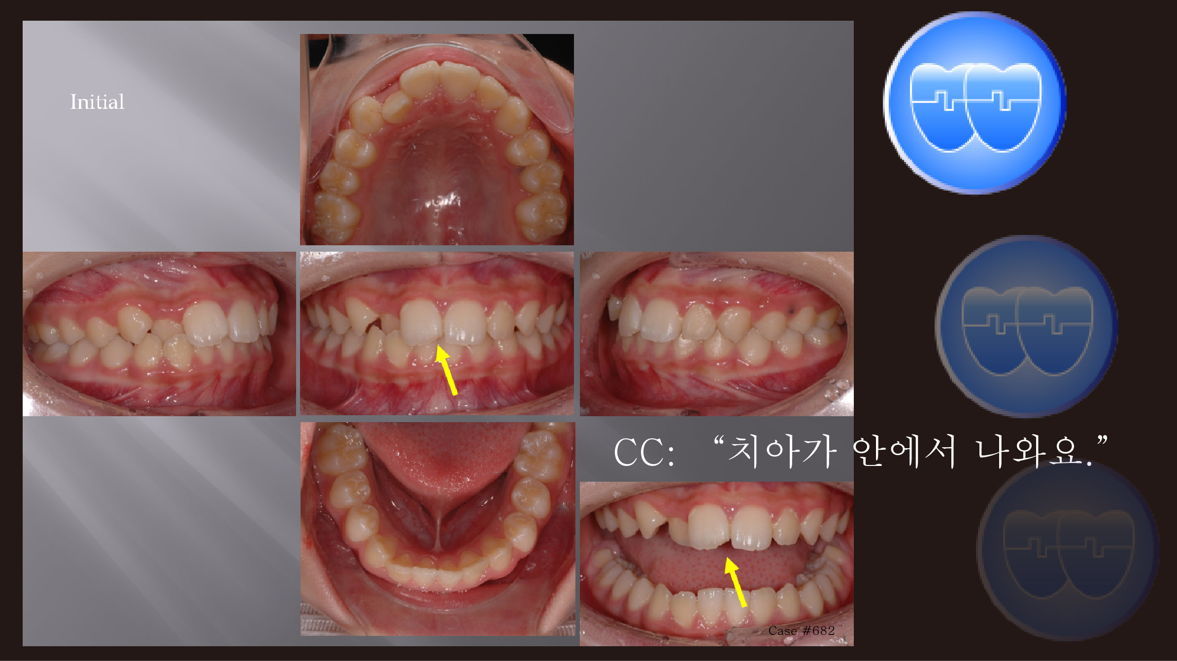 교정 Case 682. 비발치, 시갈 버튼, Broken Incisal Edge, Enameloplasty, Sem #3