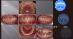 교정 Case 682. 비발치, 시갈 버튼, Broken Incisal Edge, Enameloplasty, Sem #3