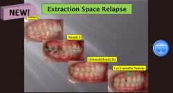 (강의 49) Sem #18 Retention and Relapse (Part II-1)-Relapse의 원인과 해결책