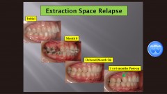 (강의 49) Sem #18 Retention and Relapse (Part II-1)-Relapse의 원인과 해결책