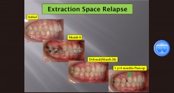 (강의 49) Sem #18 Retention and Relapse (Part II-1)-Relapse의 원인과 해결책