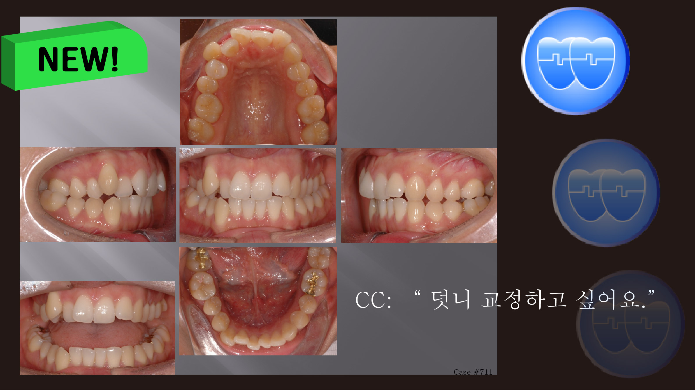 교정 Case 711. U5 발치, Bilateral Posterior Crossbite, Upper Crowding, Class II, Sem #7.8