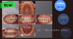 교정 Case 711. U5 발치, Bilateral Posterior Crossbite, Upper Crowding, Class II, Sem #7.8