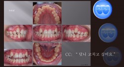 교정 Case 974.  U5L1 발치, L1 Congenital Missing, Class III, Sem #13