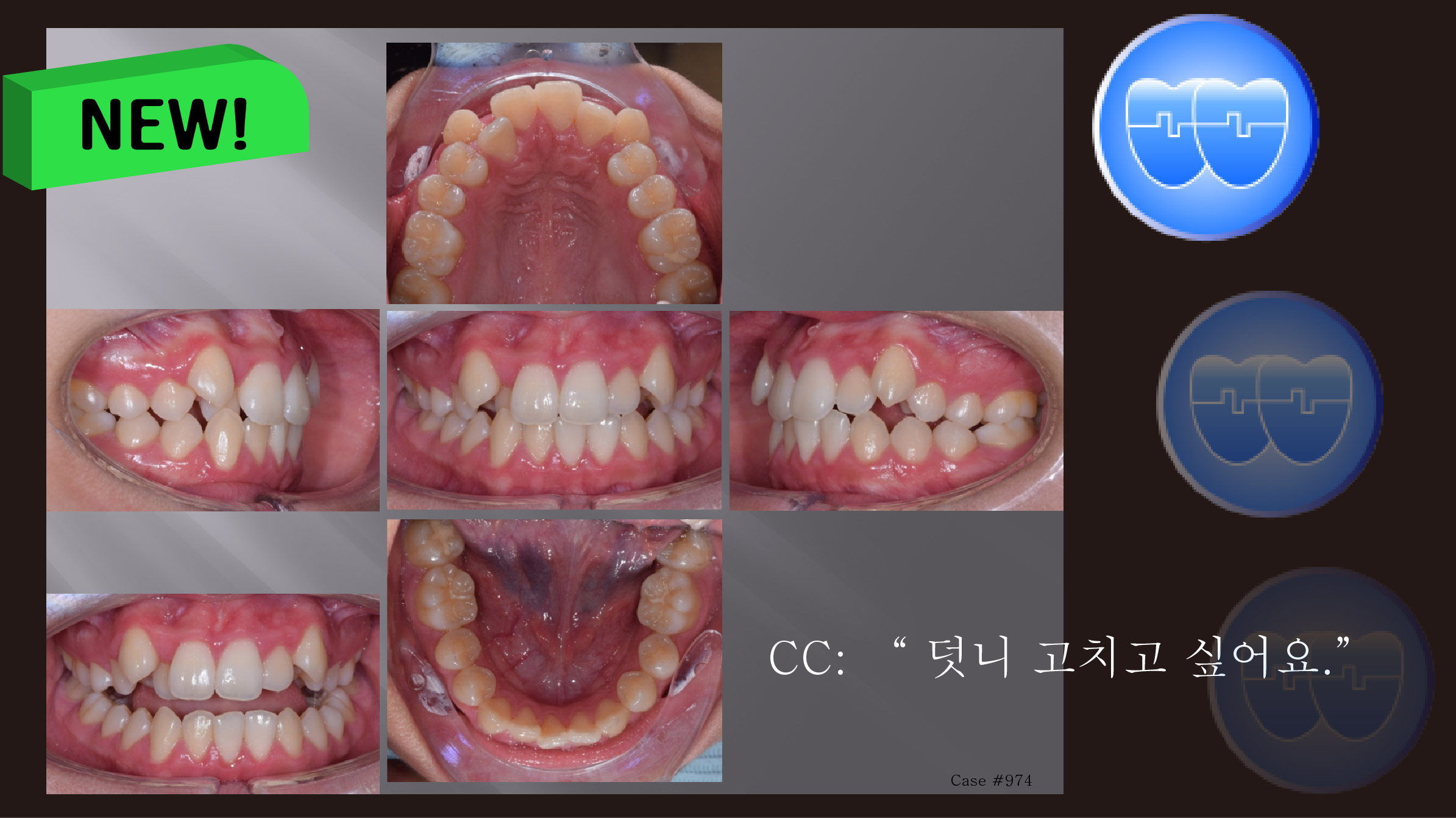 교정 Case 974.  U5L1 발치, Lower 1 Congenital Missing, Class III, Sem #13