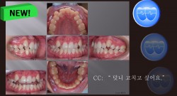 교정 Case 974.  U5L1 발치, Lower 1 Congenital Missing, Class III, Sem #13