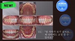 교정 Case 1319. 부분교정, Rotated Anterior Teeth, Sem #20.5