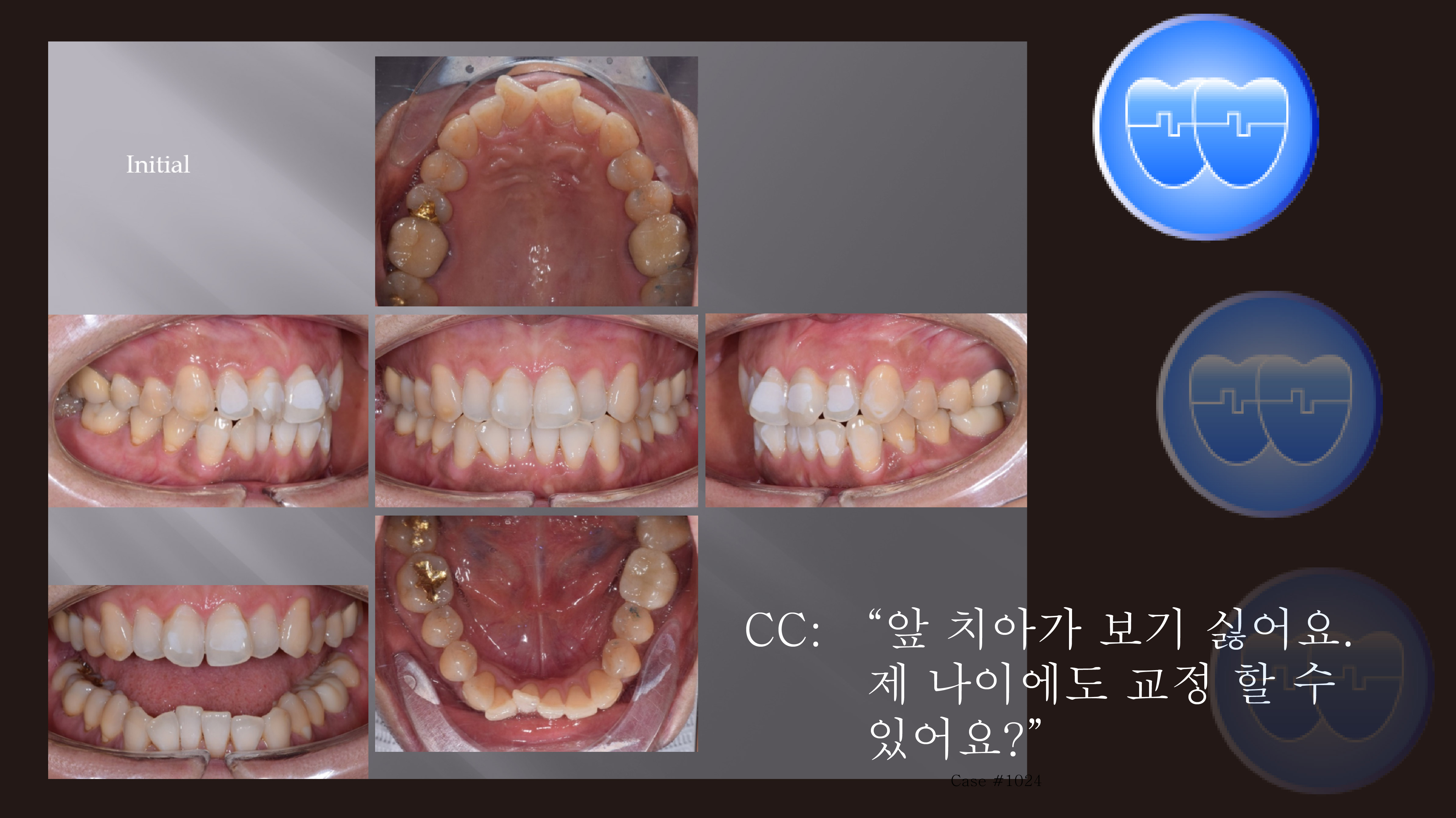 교정 Case 1319. 부분교정, Rotated Anterior Teeth, Sem #20.5