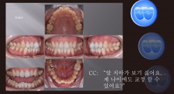 교정 Case 1319. 부분교정, Rotated Anterior Teeth, Sem #20.5