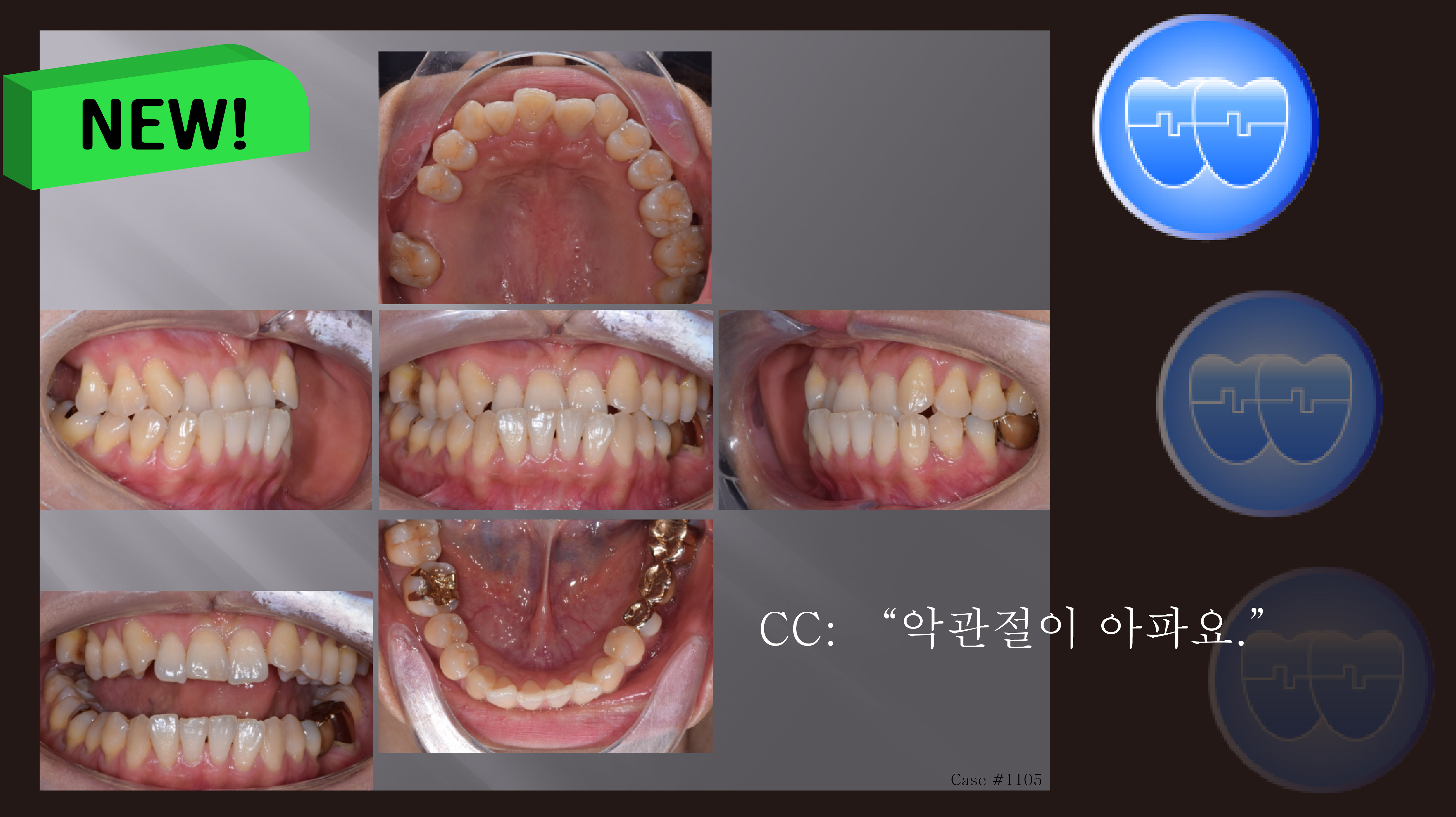 교정 Case 1105. #22 Missing, TMJ, Anterior Crossbite, Cl III, Deep Underbite, Sem #19