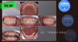 교정 Case 1105. #22 Missing, TMJ, Anterior Crossbite, Cl III, Deep Underbite, Sem #19