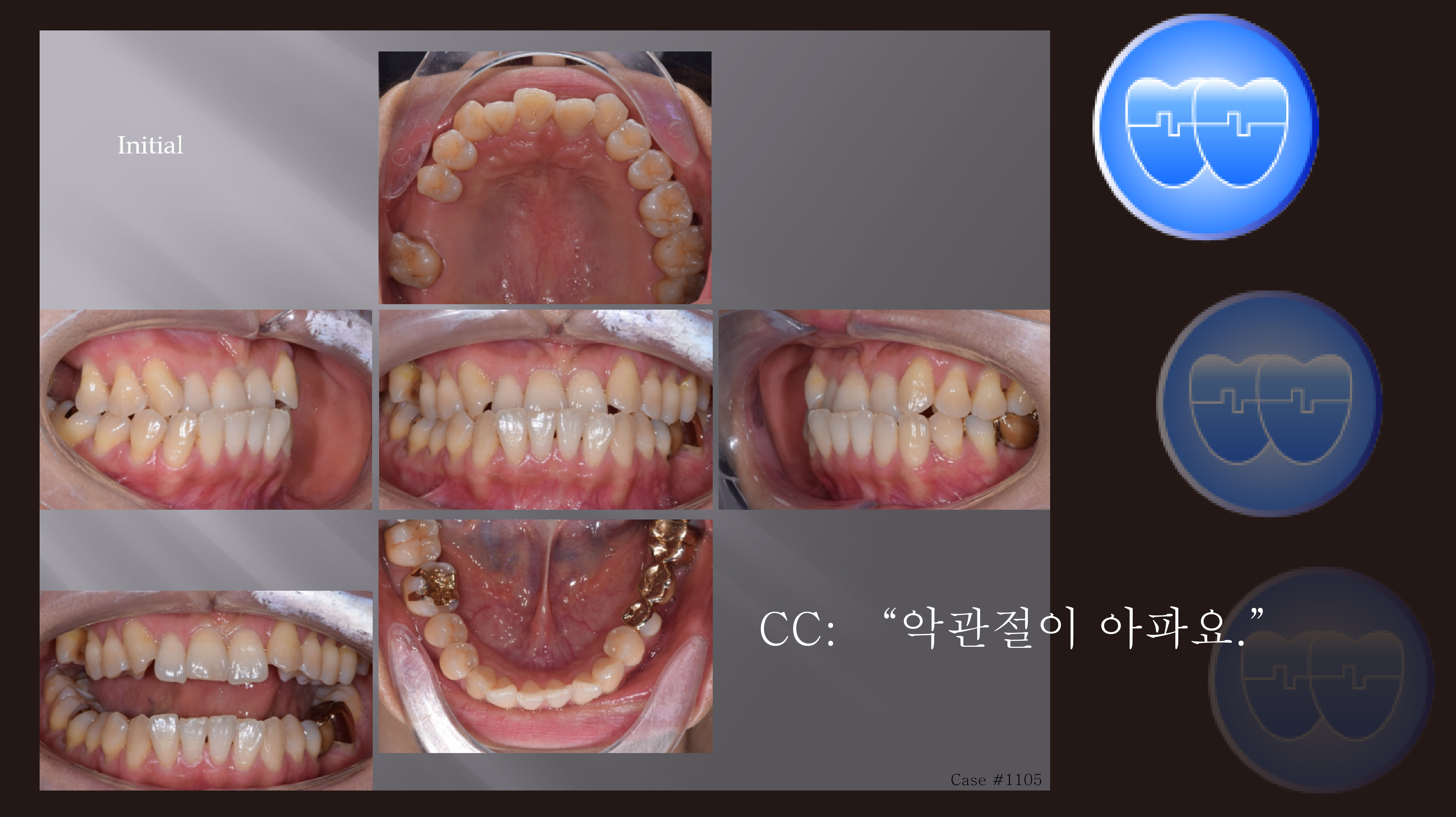 교정 Case 1105.  #22 Missing, TMJ, Anterior Crossbite, Cl III, Deep Underbite, Sem #19