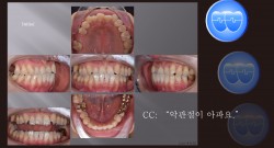 교정 Case 1105.  #22 Missing, TMJ, Anterior Crossbite, Cl III, Deep Underbite, Sem #19