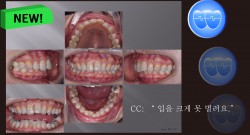 교정 Case 1117. 비발치, TMJ, Dental Deepbite, Sem #19