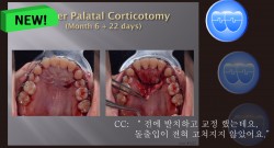 교정 Case 1227. Transferred Pt., Protrusion, U & L Corticotomy, Gummy Smile, Sem #13.7(New,로고)