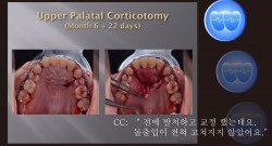 교정 Case 1227. Transferred Pt., Protrusion, U & L Corticotomy, Gummy Smile, Sem #13.7(New,로고)