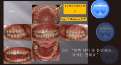 교정 Case 777. U5L4 발치, Ectopic Eruption, Functional Shift, Lower Lingual Corticotomy for Lower Torque Control, Sem #19