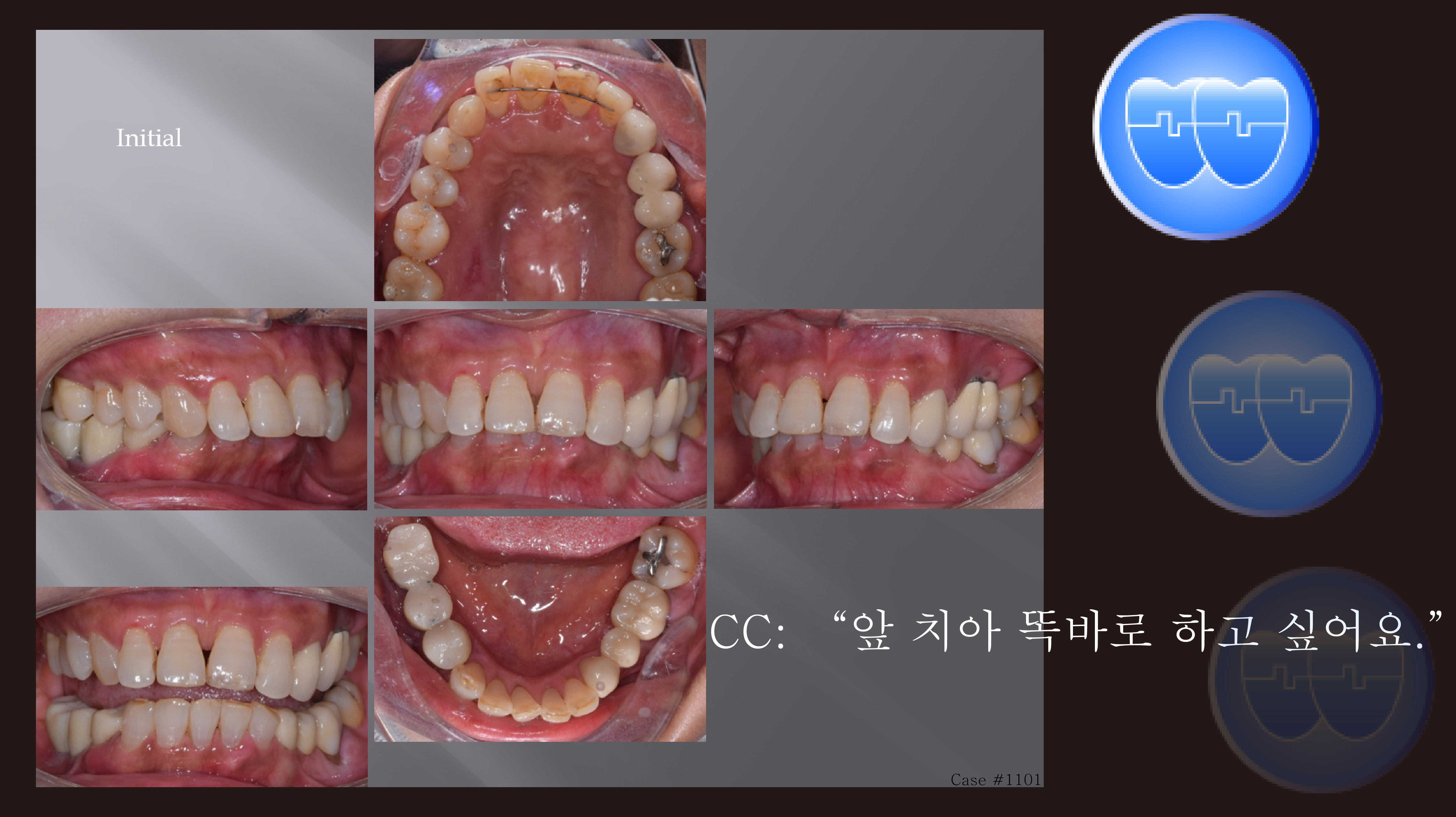 교정 Case 1101. 부분교정, TMJ 통증호소, Deepbite, Sem#19