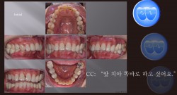 교정 Case 1101. 부분교정, TMJ 통증호소, Deepbite, Sem#19