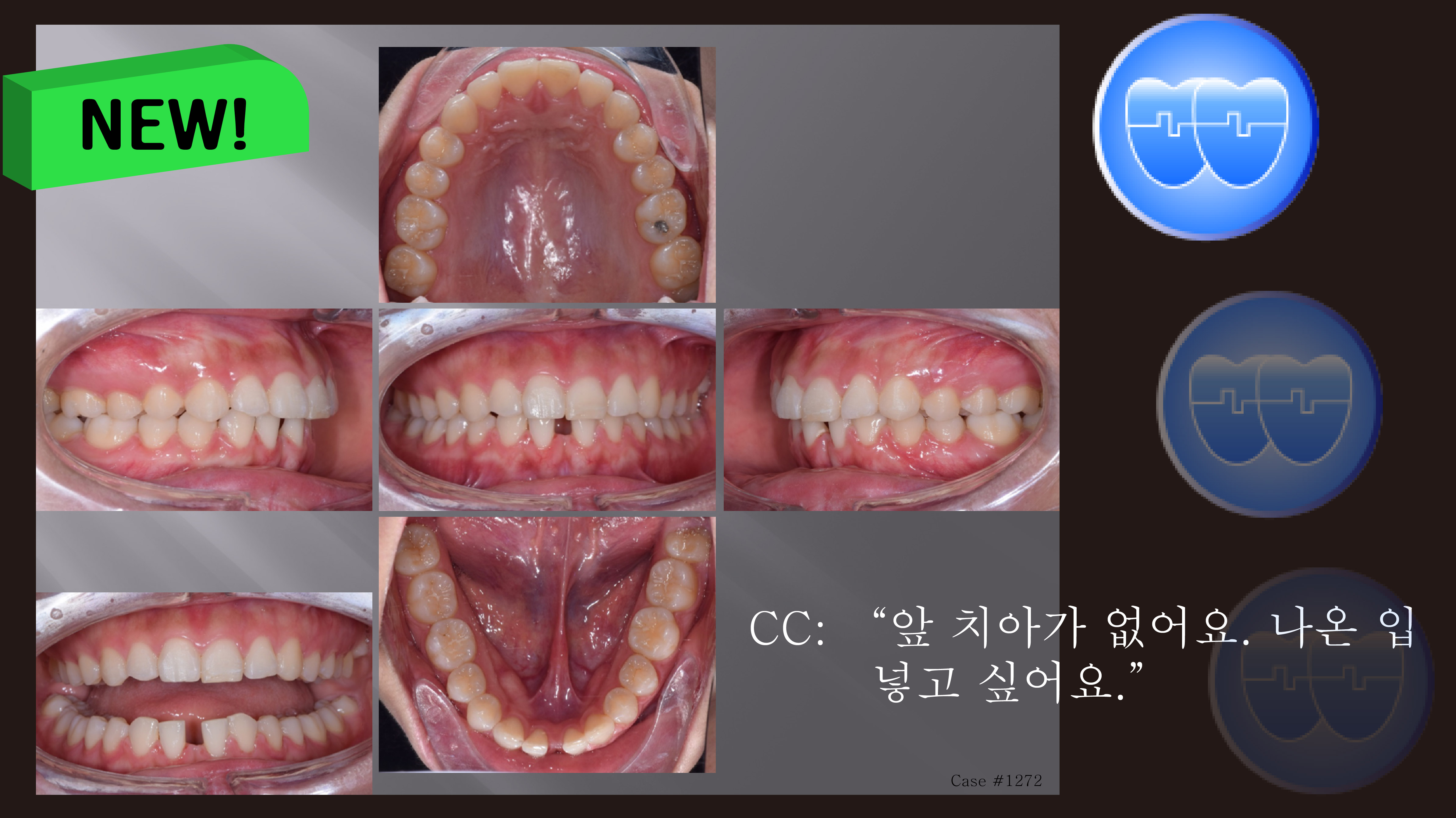 교정 Case 1272. U5L2 발치, Congenital Missing Two L. Incisors, Root Resorption, Sem #13