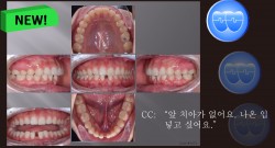 교정 Case 1272. U5L2 발치, Congenital Missing Two L. Incisors, Root Resorption, Sem #13