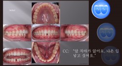 교정 Case 1272. U5L2 발치, Congenital Missing Two L. Incisors, Root Resorption, Sem #13