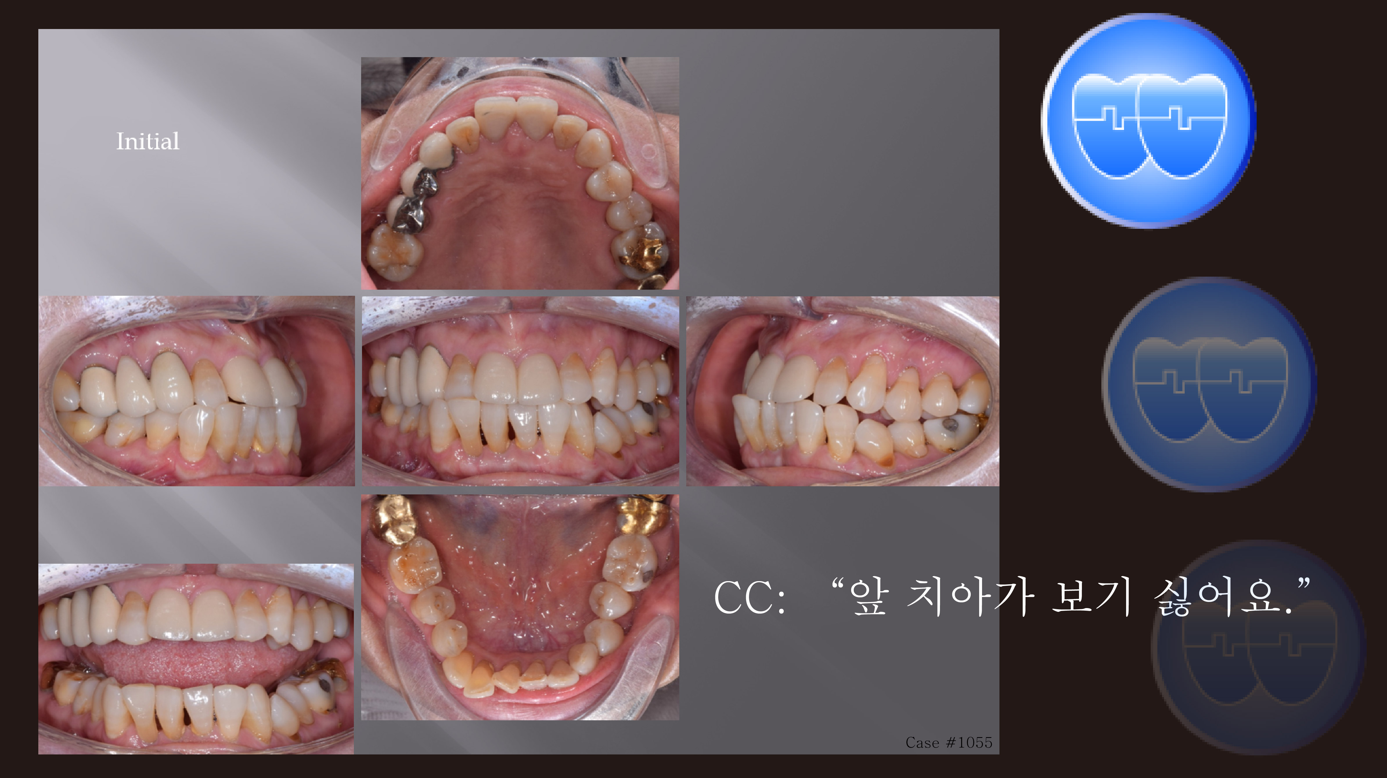 교정 Case 1055. 비발치, 성인 부분교정, TMJ, Sem #19