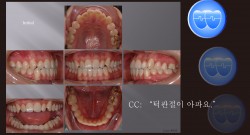 교정 Case 892. 비발치, TMJ Patient, Sem #19