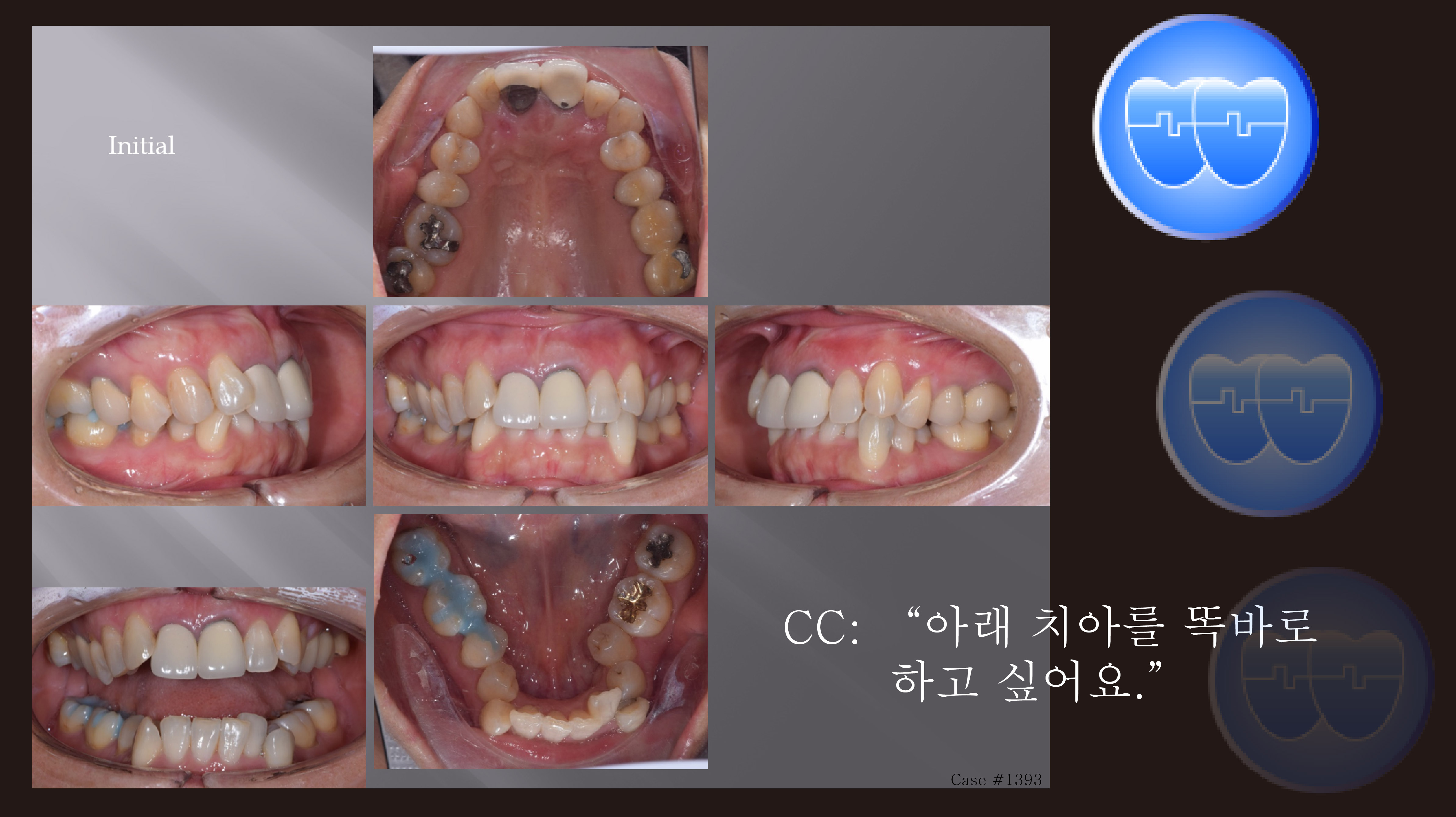 교정 Case 1393. 부분교정, Severe Lower Crowding, Expansion and IPR로 해결, Sem #20.5