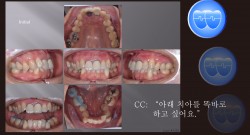 교정 Case 1393. 부분교정, Severe Lower Crowding, Expansion and IPR로 해결, Sem #20.5