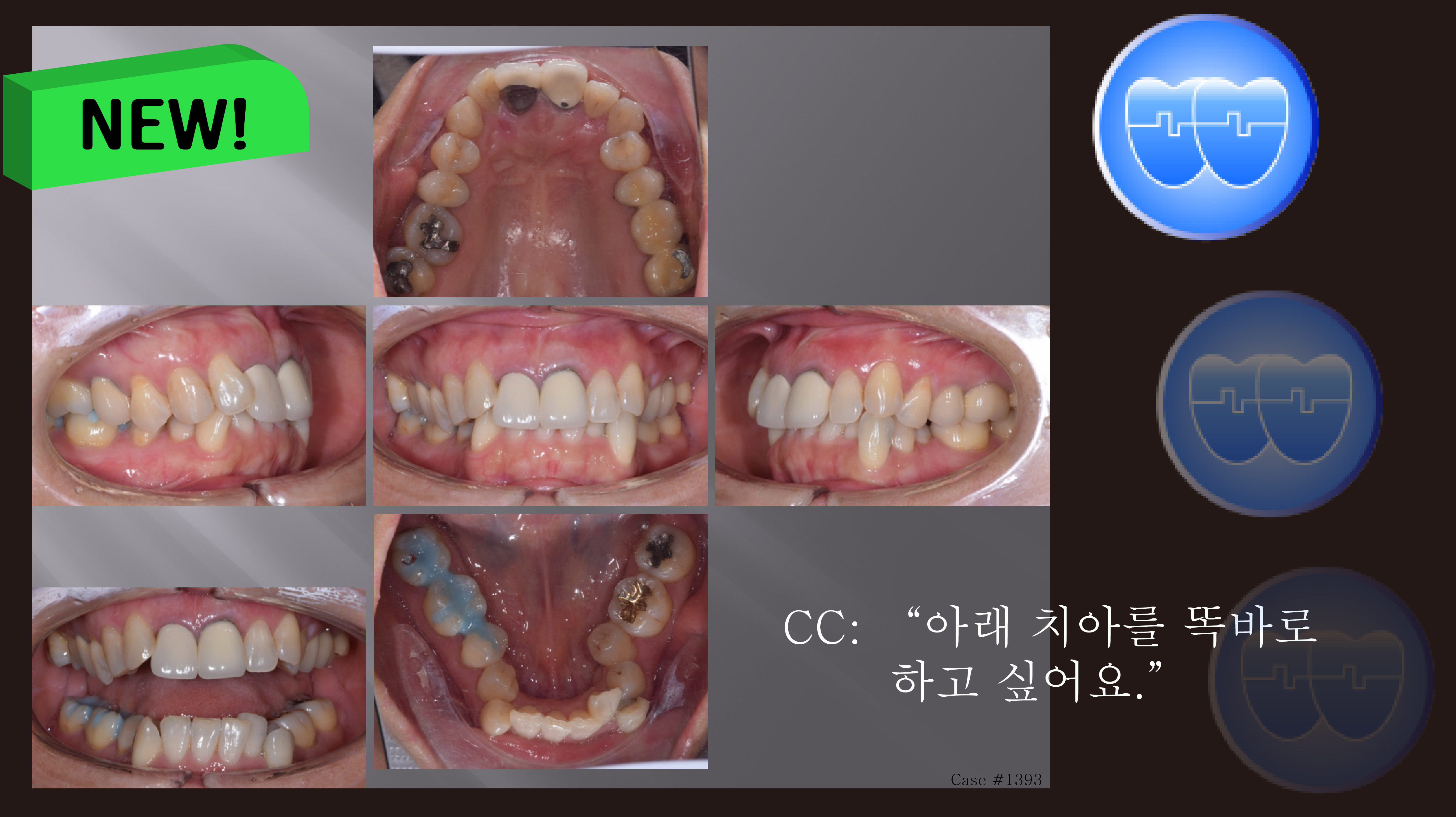 교정 Case 1393. 부분교정, Severe Lower Crowding, Expansion and IPR로 해결, Sem #20.5