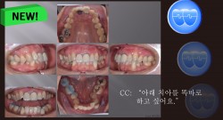 교정 Case 1393. 부분교정, Severe Lower Crowding, Expansion and IPR로 해결, Sem #20.5