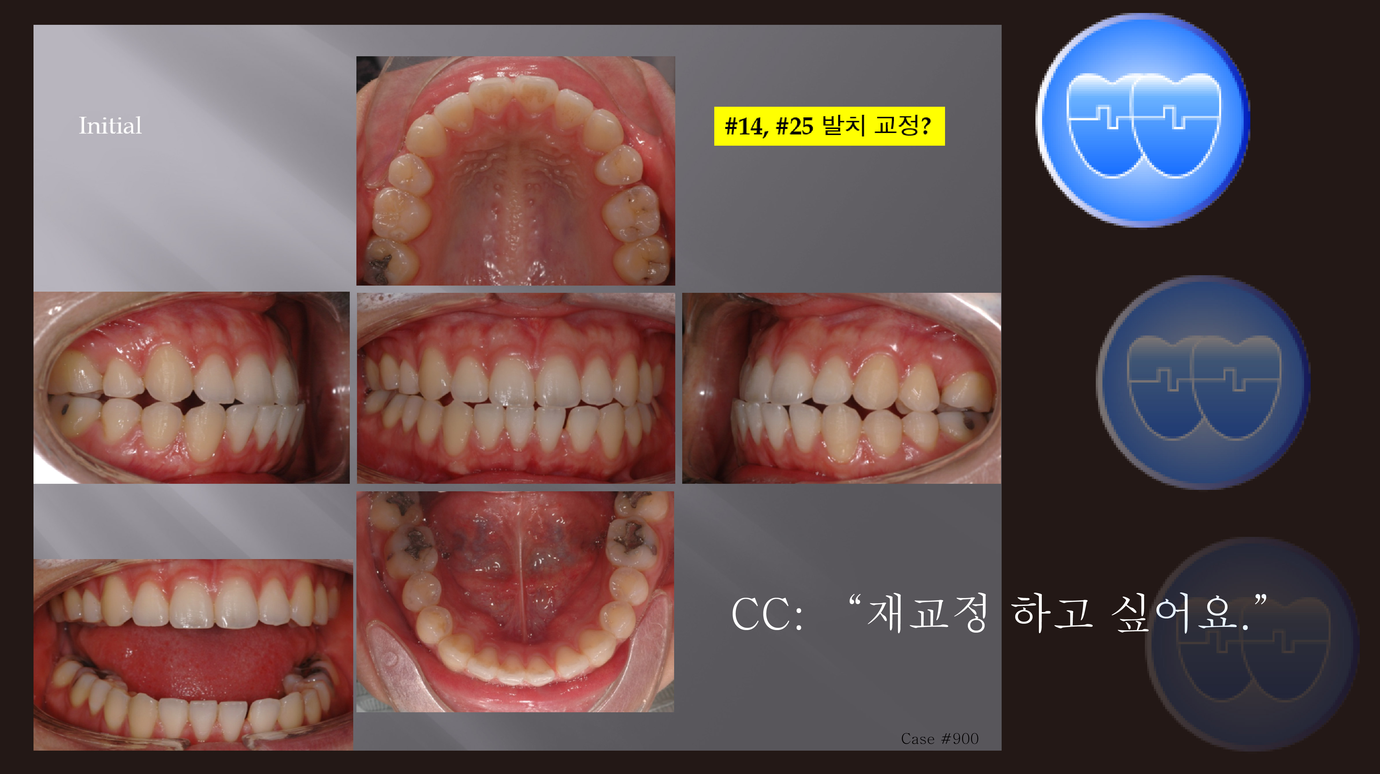 교정 Case 900. 재교정, Lower Lingual Corticotomy, L5번 Root가 Buccal로 튀어 나감, Sem #13.7