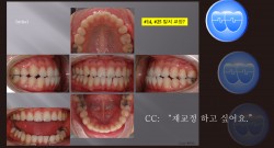 교정 Case 900. 재교정, Lower Lingual Corticotomy, L5번 Root가 Buccal로 튀어 나감, Sem #13.7