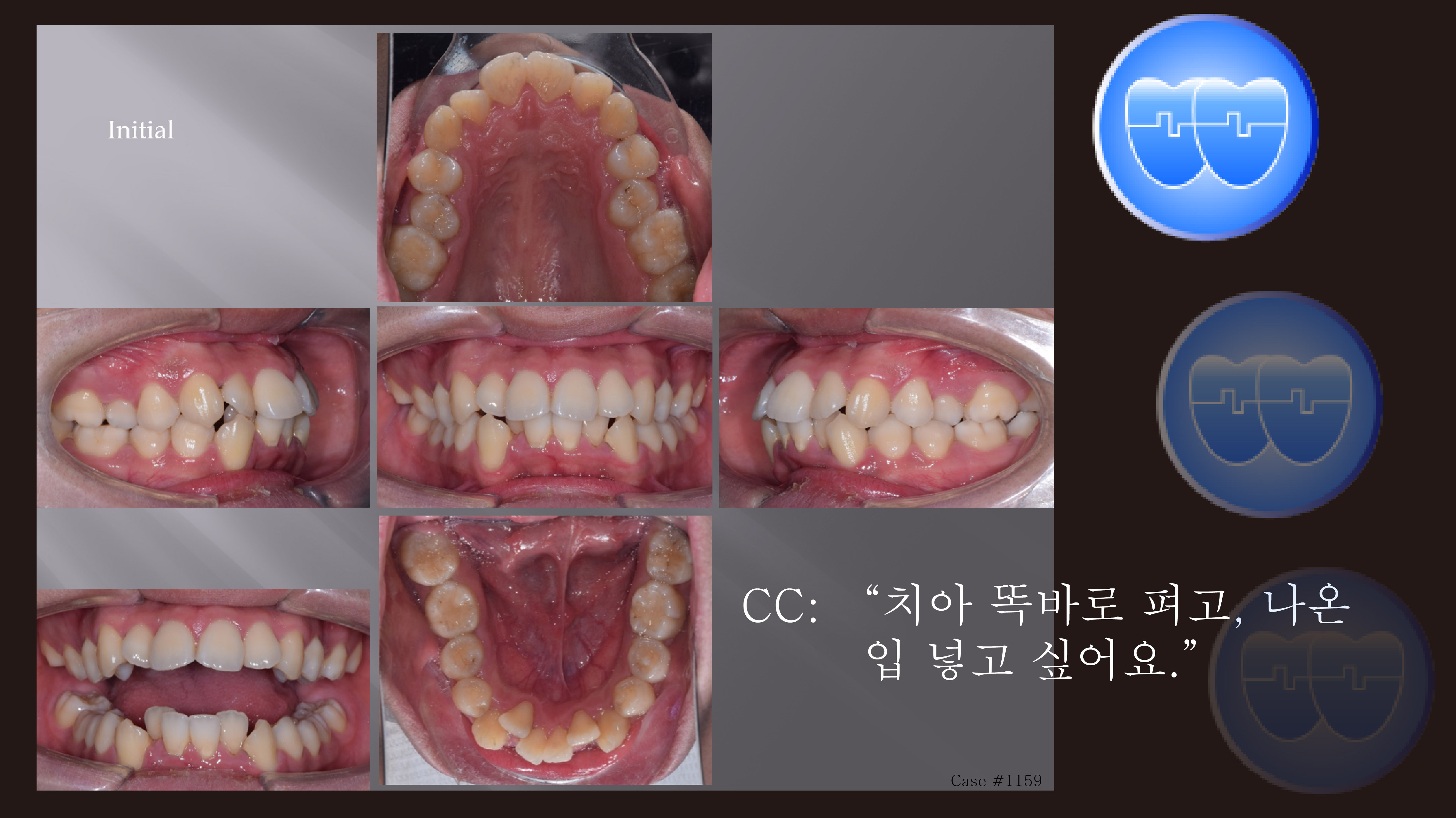 교정 Case 1159. U5L5 발치, Sk. Resistance, Corticotomy 거부, Molar Root Perforation Out of Cortical Bone, Sem #13.7(로고)