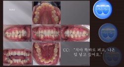 교정 Case 1159. U5L5 발치, Sk. Resistance, Corticotomy 거부, Molar Root Perforation Out of Cortical Bone, Sem #13.7(로고)