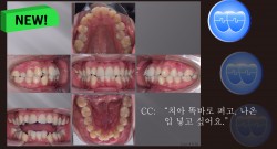 교정 Case 1159. U5L5 발치, Sk. Resistance, Corticotomy 거부, Molar Root Perforation Out of Cortical Bone, Sem #13.7