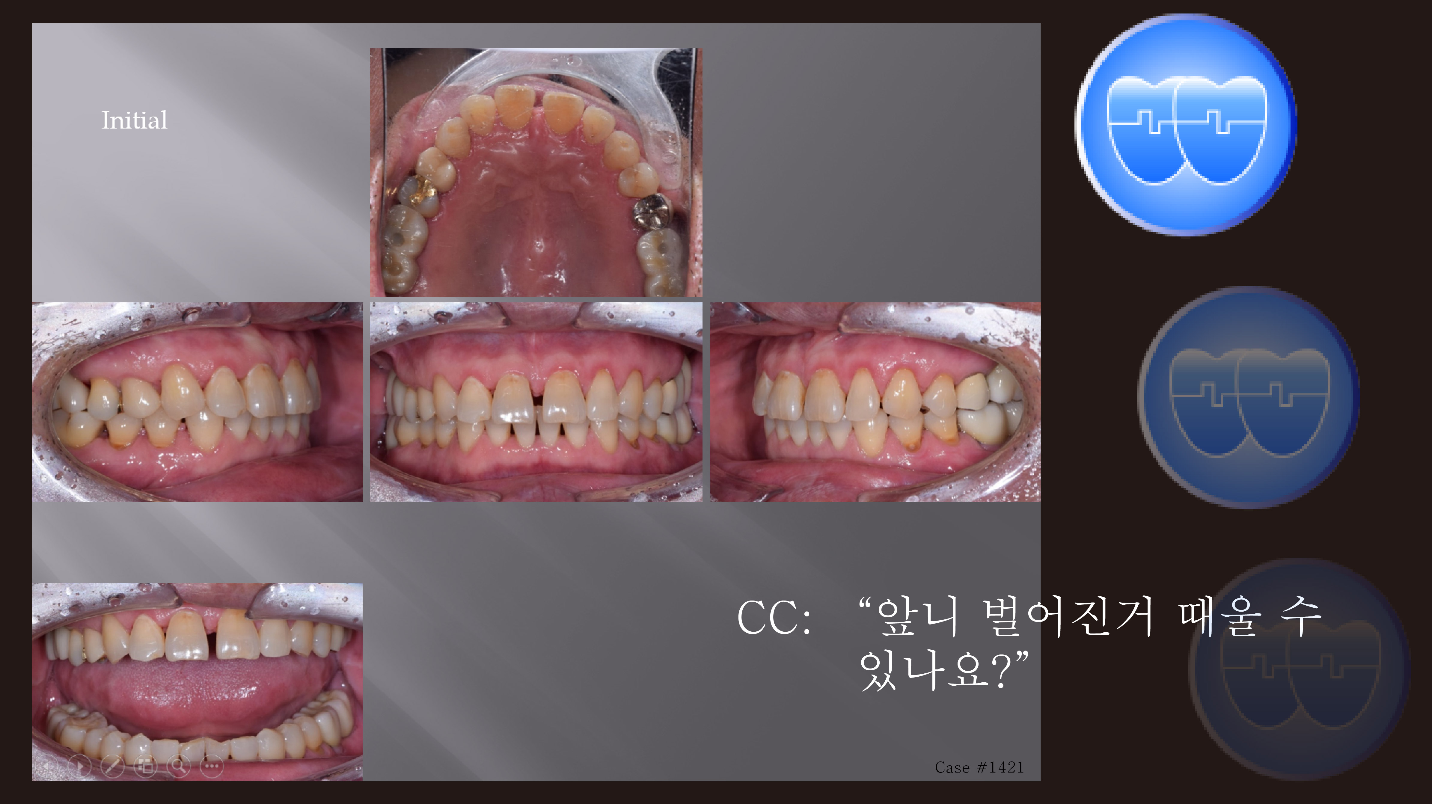 교정 Case 1421. Difficulty of Anterior Space Closing with Power Chain, Sem # 20.5