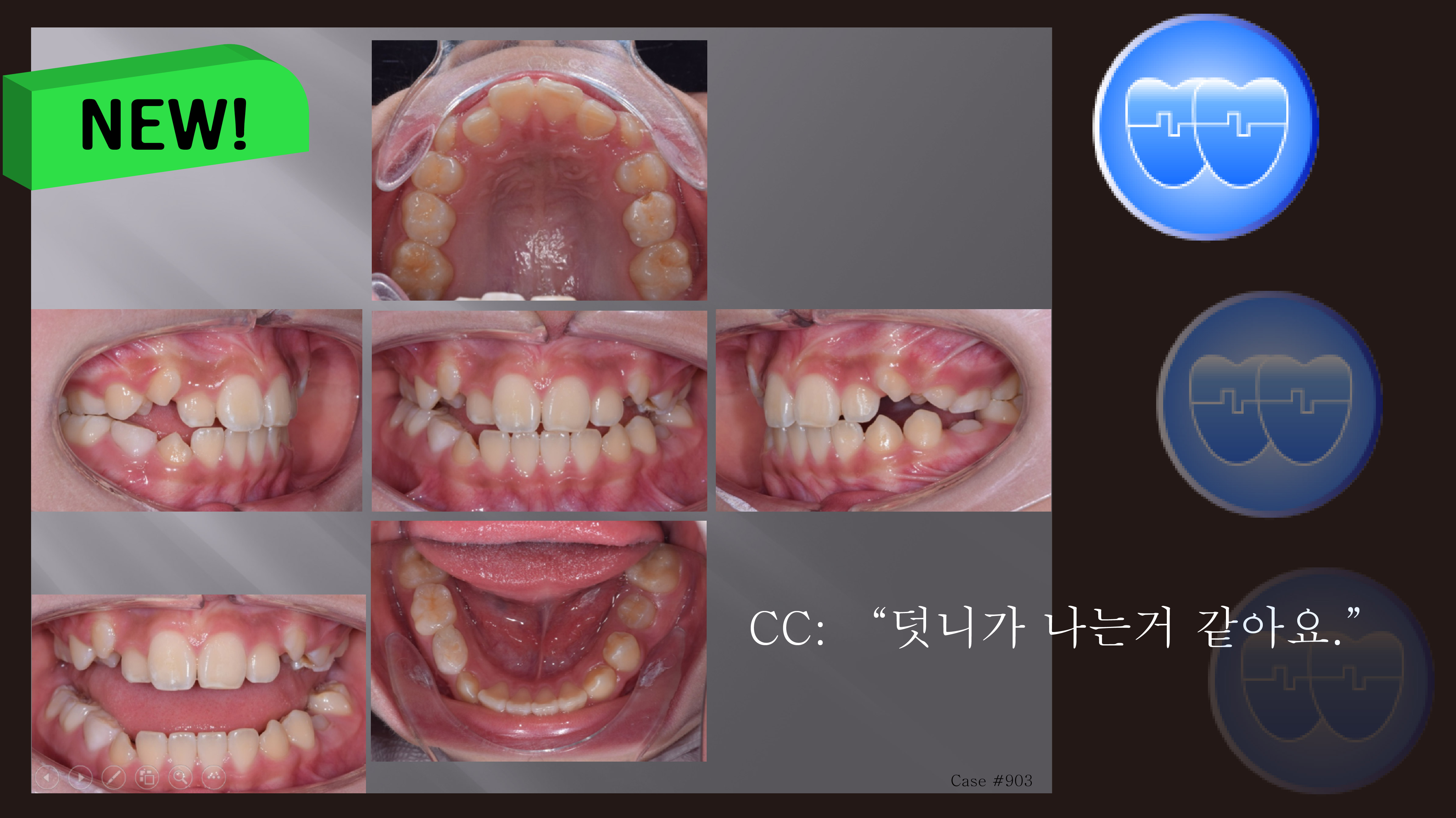 교정 Case 903. 비발치, Protrusion, Early DBS의 장점, Sem #11