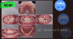 교정 Case 903. 비발치, Protrusion, Early DBS의 장점, Sem #11