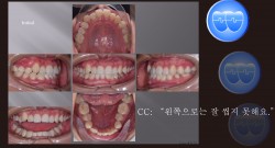 교정 Case 1173. U5 발치, Unilateral Scissor Bite, Upper Arch Constriction, Malformed L. Teeth, Sem #7.8