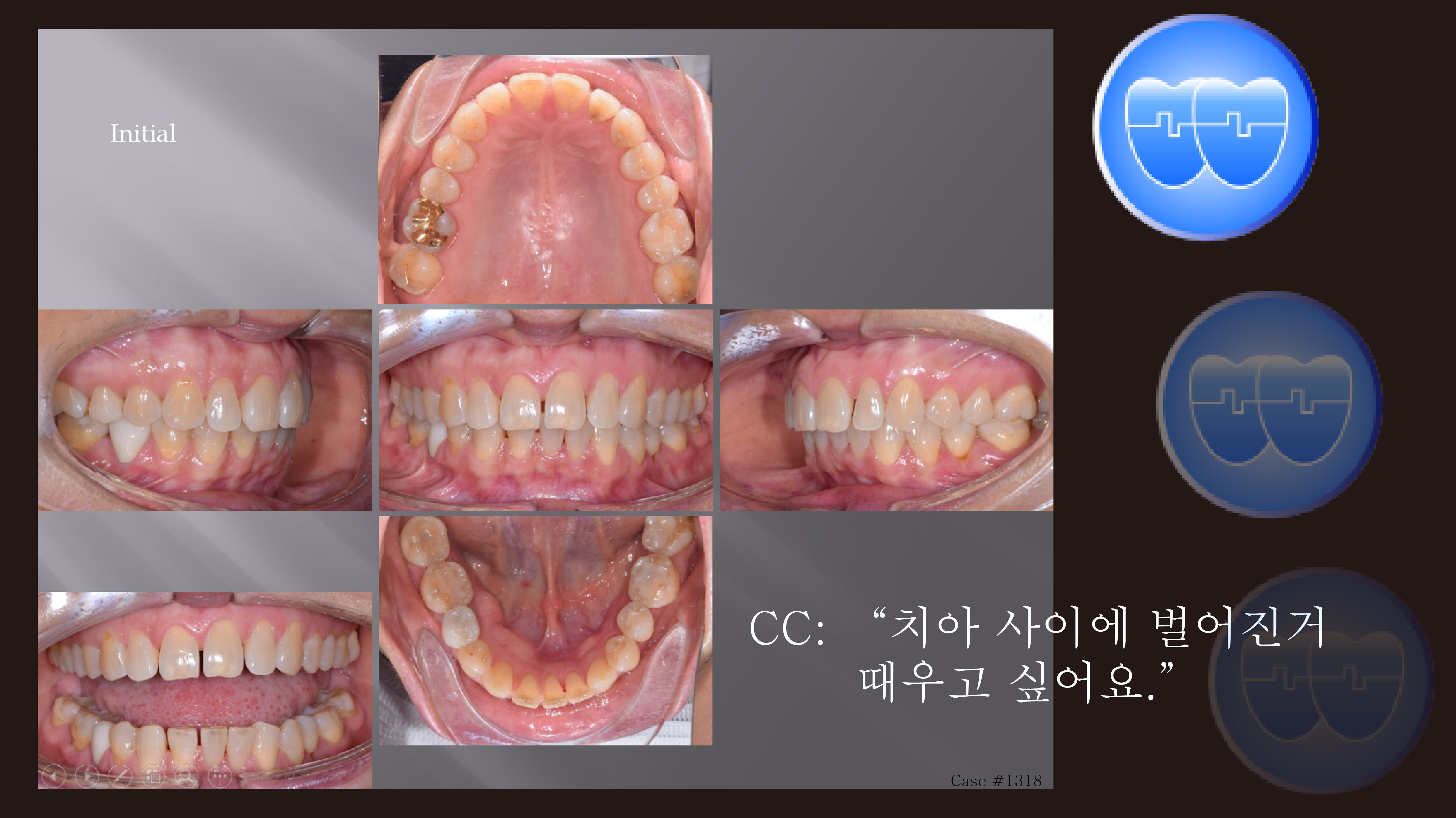 교정 Case 1318. 부분교정, Anterior Space Closing, Sem #20.5